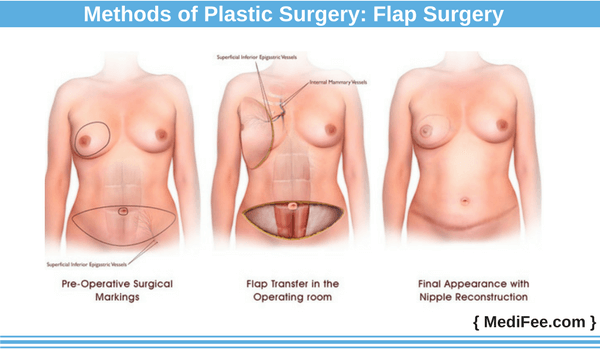 method of plastic surgery: flap Surgery plastic flap surgery method