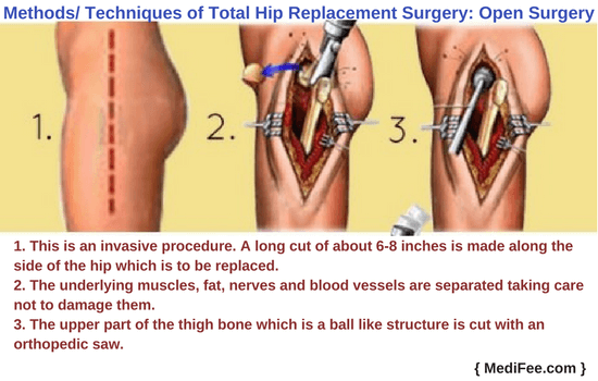 Care of hip prothesis