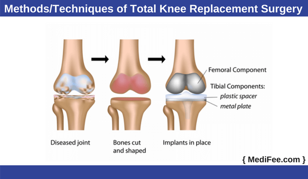 method of total knee replacement surgery