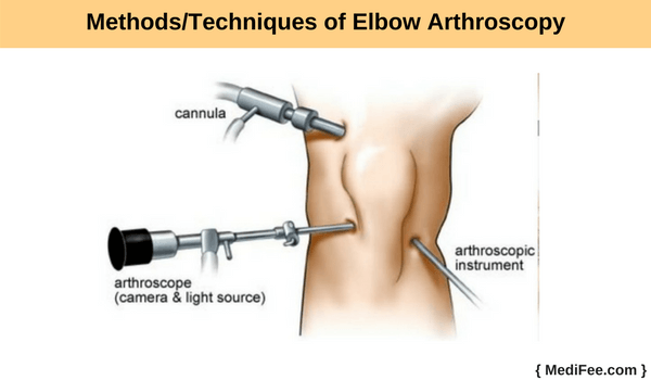 methods of elbow arthroscopy methods of elbow arthroscopy