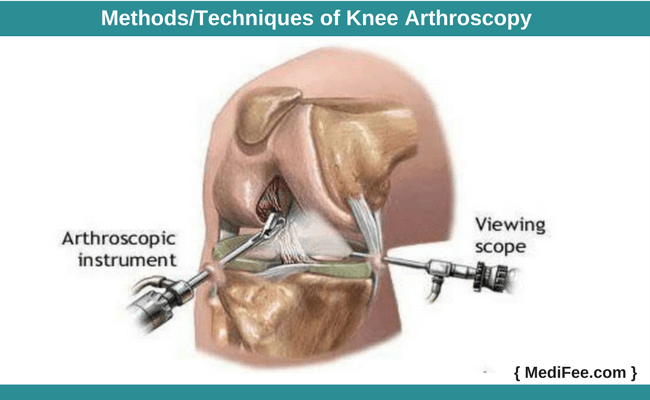 methods of knee arthroscopy