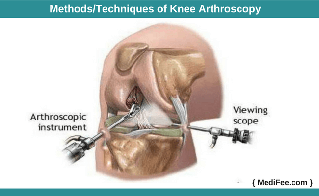 methods of knee arthroscopy methods of knee arthroscopy