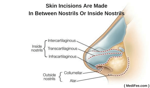 rhinoplasty methods 