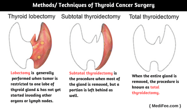 methods of thyroid cancer surgery