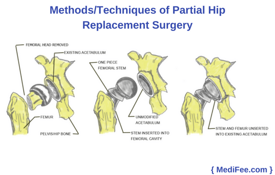 methods of partial hip replacement surgery methods of partial hip replacement surgery