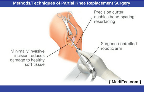 methods partial knee replacement