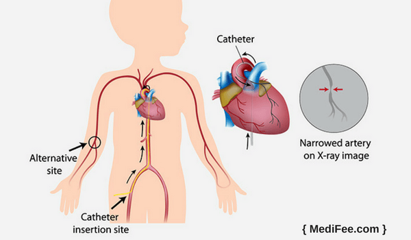 methods techniques cardiac catheterization