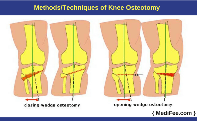 Knee Osteotomy Surgery And Recovery