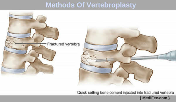 methods of vertebroplasty methods of vertebroplasty