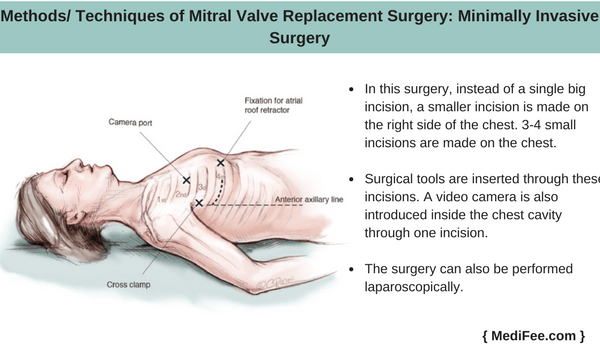 minimally invasive surgery