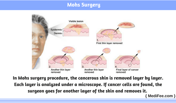 mohs surgery