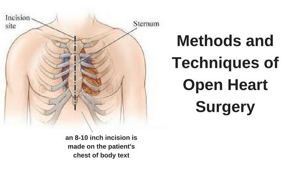 procedure for open heart surgery dopen heart procedure