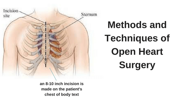 dopen heart procedure