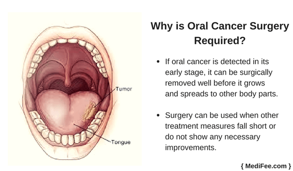 Oral Cancer Treatment Surgery And Related Risk Factors 