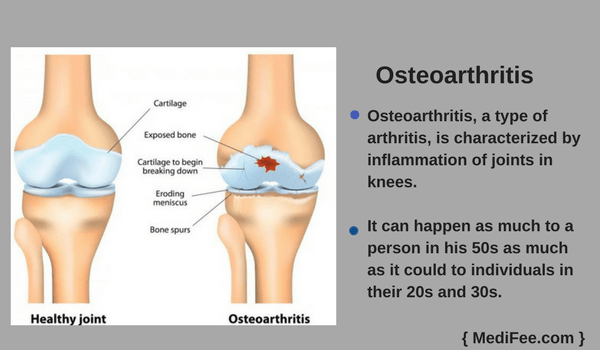 osteoarthritis
