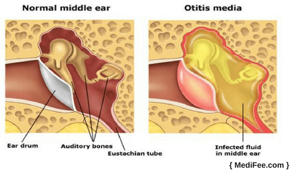 otitis media