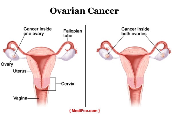 ovarian cancer