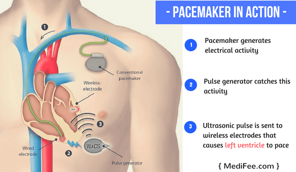 pacemaker surgery in India