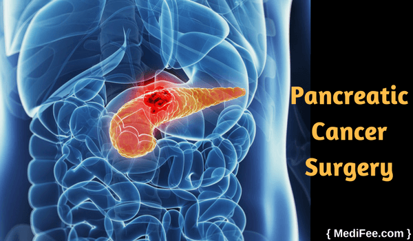 pancreatic cancer surgery