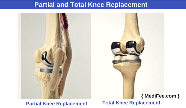 partial-total knee replacement