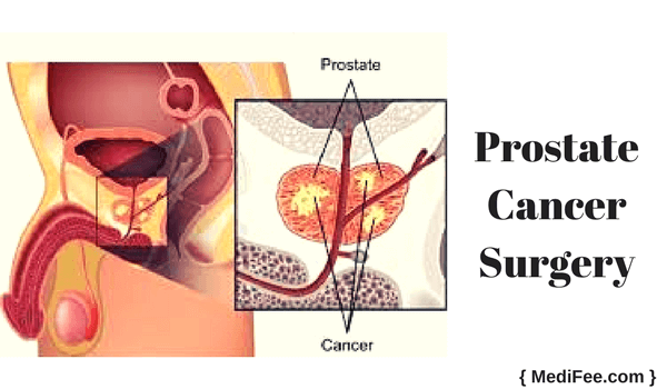 prostate cancer surgery
