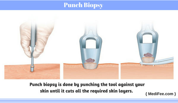 punch biopsy