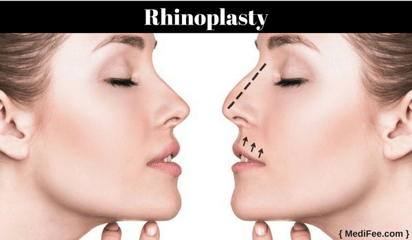 rhinoplasty cosmetic procedure to refine nose 