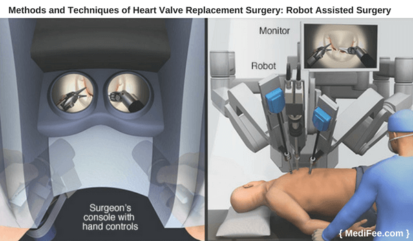 robot sssisted surgery