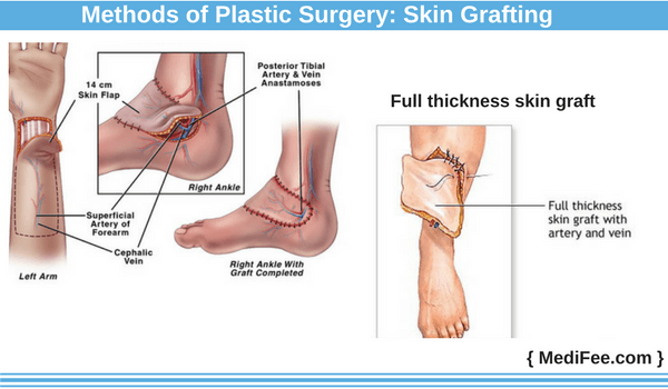 skin grafting method of plastic surgery what is skin grafting method