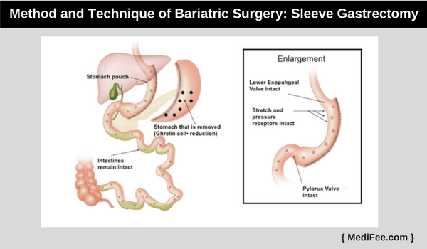 Sleeve Gastrectomy Sleeve Gastrectomy