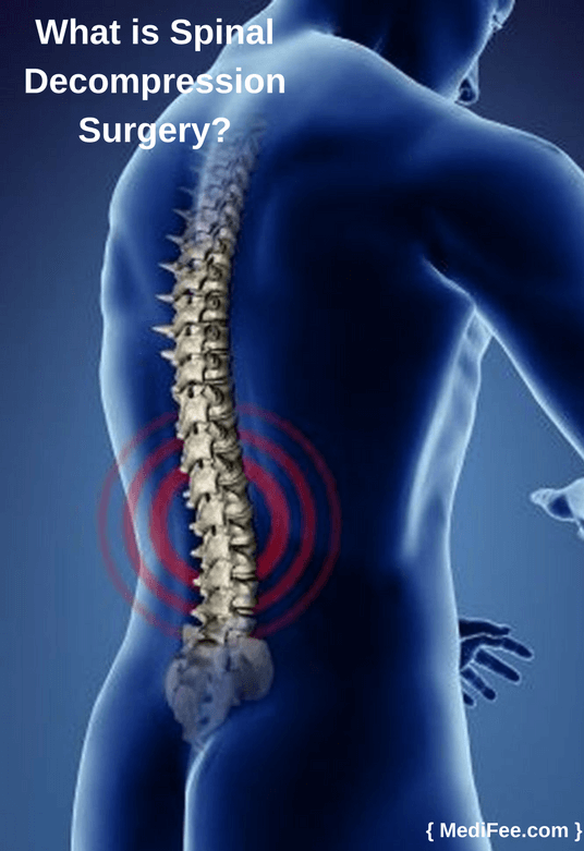 spinal decompression surgery