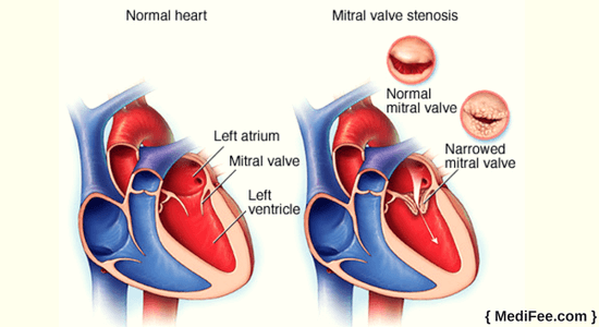 mitral stenosis