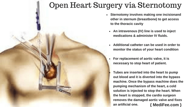 sternotomy