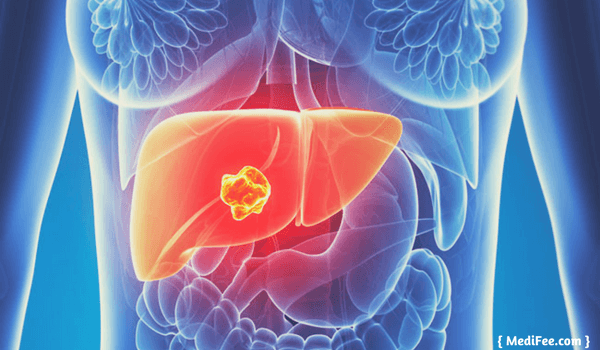 surgery to treat liver cancer