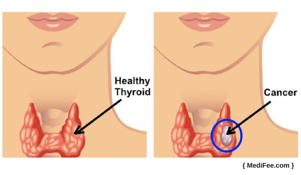 thyroid cancer