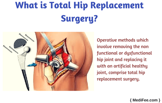 Hip Replacement Surgery >> Total Hip Replacement Surgery Hip Replacement Surgery >> Total Hip Replacement Surgery