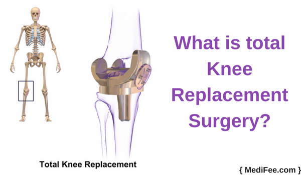 total knee replacement surgery total knee replacement surgery