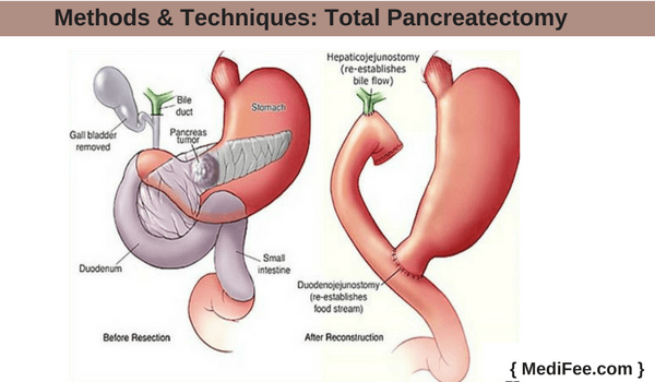 total pancreatectomy total Pancreatectomy