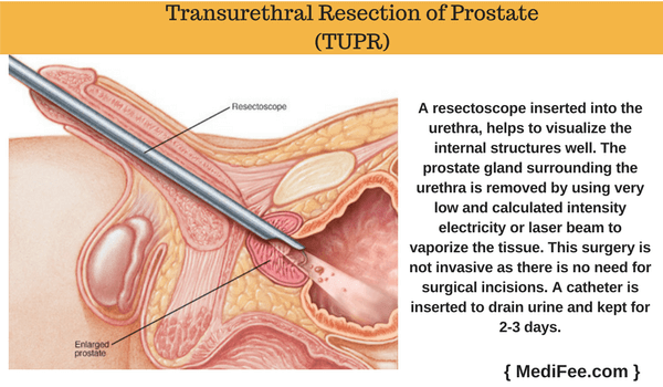 transurethral resection of prostate