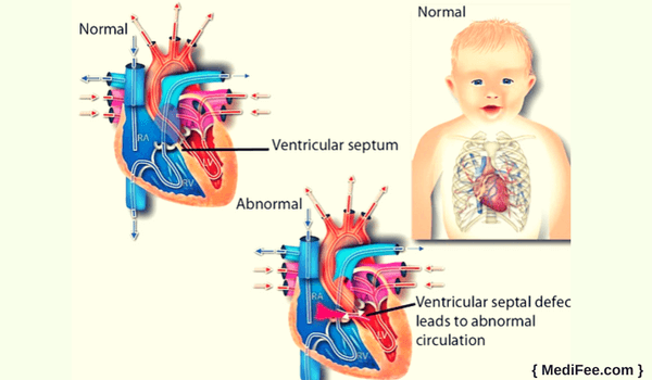 ventricular septal defect surgery