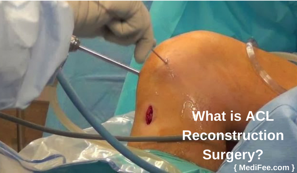 what is acl reconstruction surgery what is acl reconstruction surgery