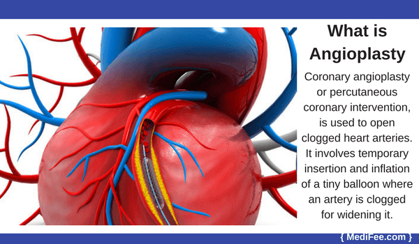 what is angioplasty what is angioplasty