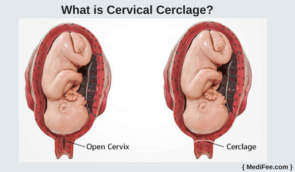 what is cervicar cerclage