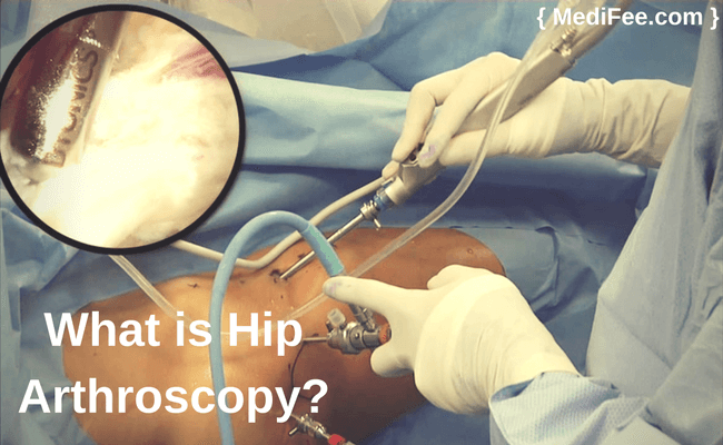 what is hip arthroscopy