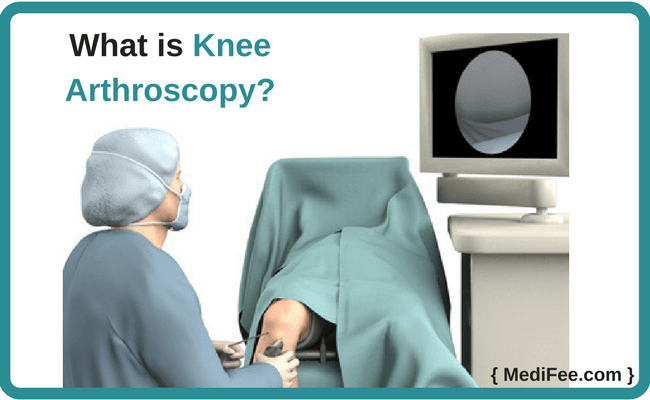 what is knee arthroscopy