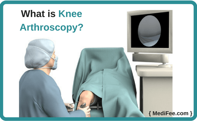 what is knee arthroscopy what is knee arthroscopy
