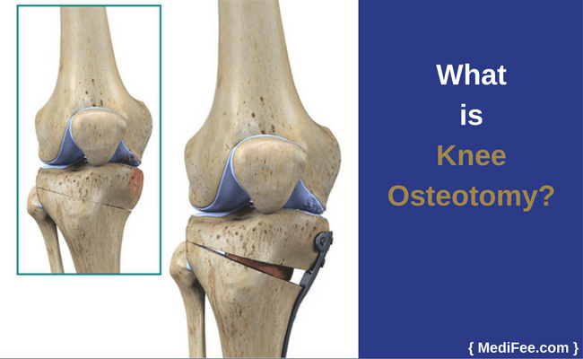 what is knee osteotomy what is knee osteotomy