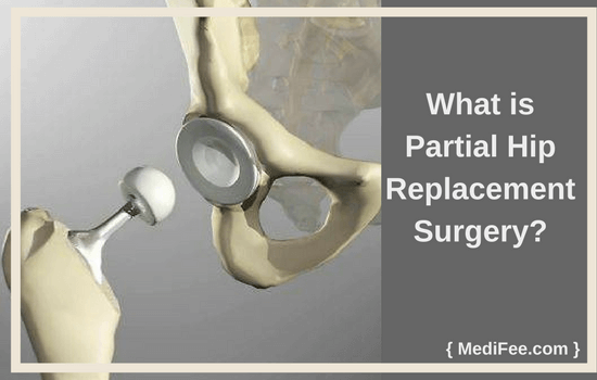 Which Method Of Hip Replacement Is The Best Designtapeter