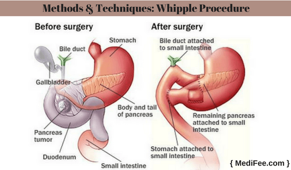 whipple procedure