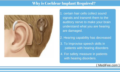 need of cochlear implant